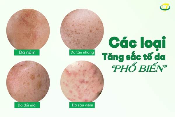 4 loại tăng sắc tố trên da phổ biến